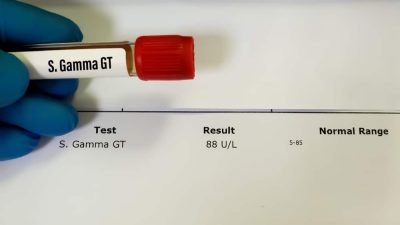 gamma-gt-echantillon