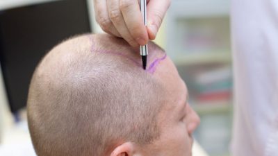 consultation-greffe-cheveux