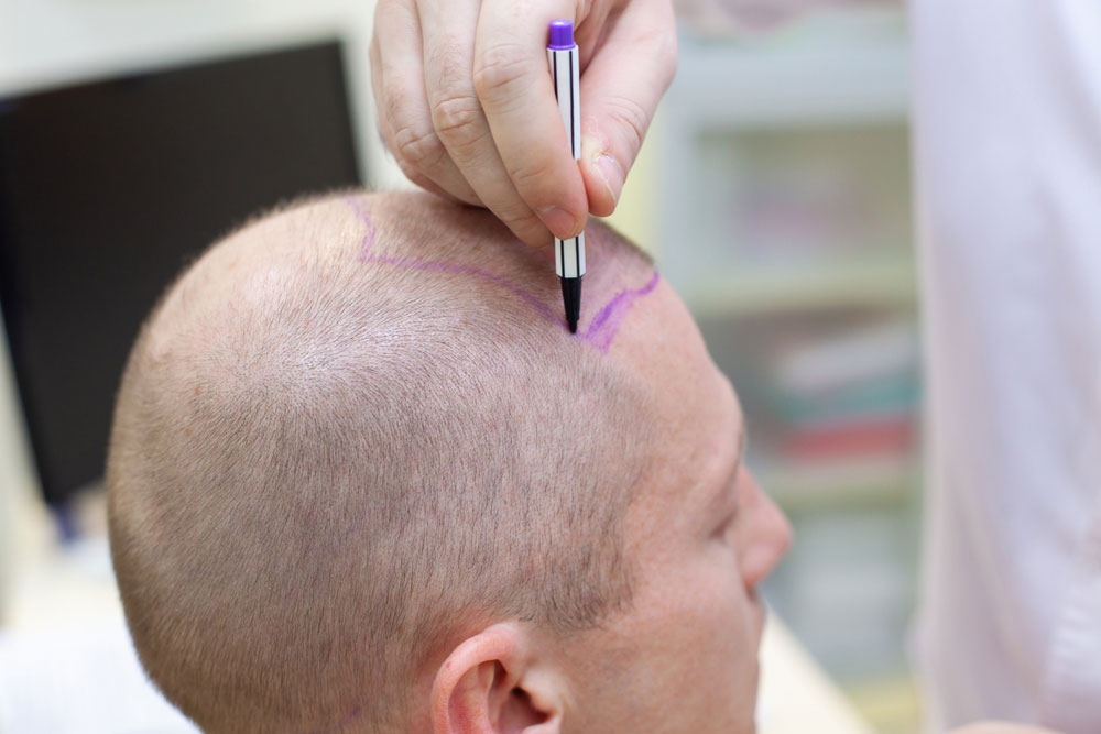 consultation-greffe-cheveux