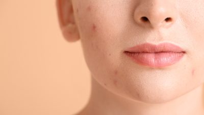femme avec acne