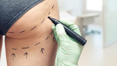 chirurgie esthétique fesse