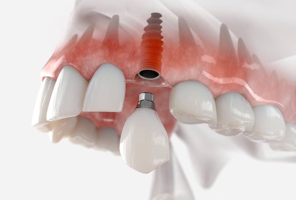 implant dentaire
