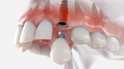 implant dentaire