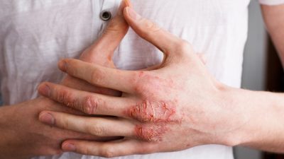 eczema mains