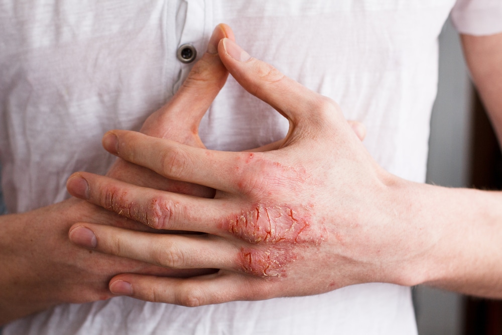 eczema mains