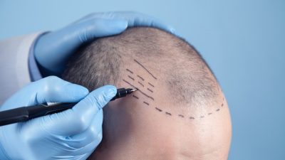 chirurgien prepare greffe de cheveux