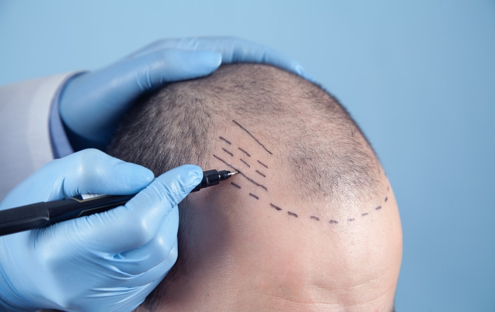 chirurgien prepare greffe de cheveux