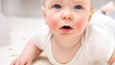 dermatite atopique visage bebe