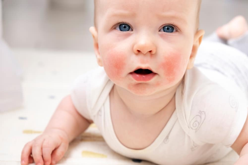 dermatite atopique visage bebe